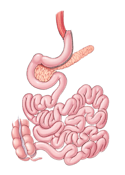 illustration of gastric sleeve