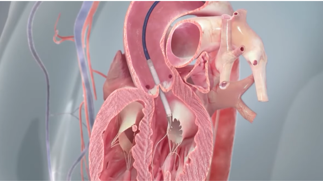 Treating aortic stenosis with TAVR