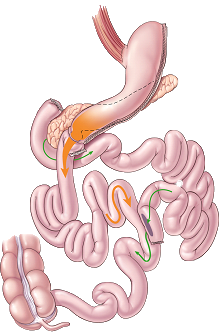 Duodenal Switch diagram